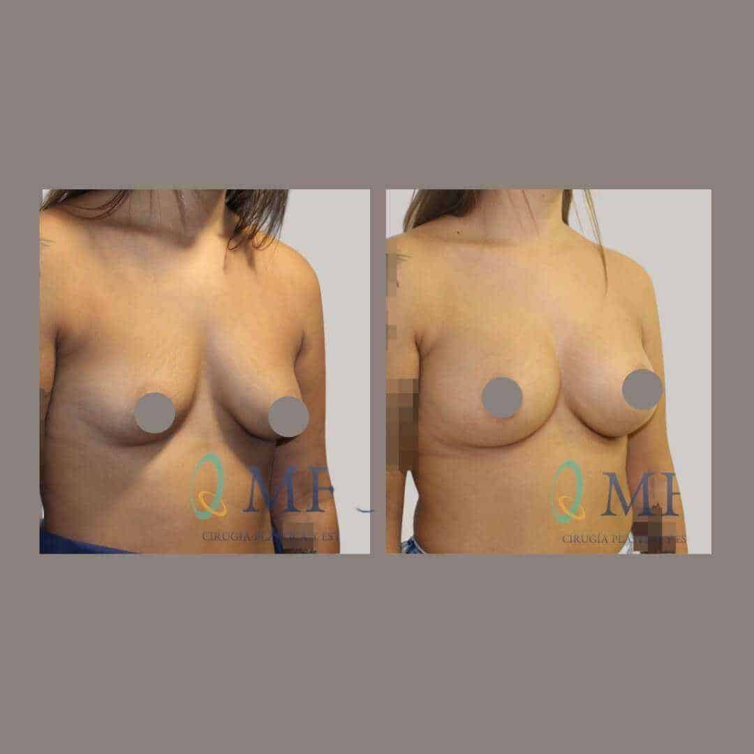 Asimetria mamaria pecho tuberoso (1)