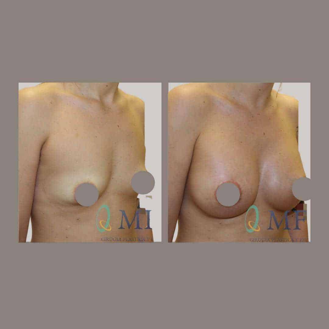 Asimetria mamaria pecho tuberoso (10)