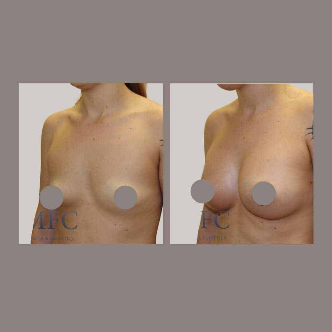 Asimetria mamaria pecho tuberoso (11)