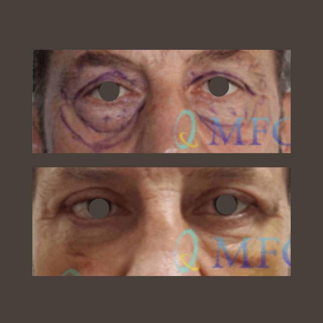 cirugia arrugas ojos madrid (2)