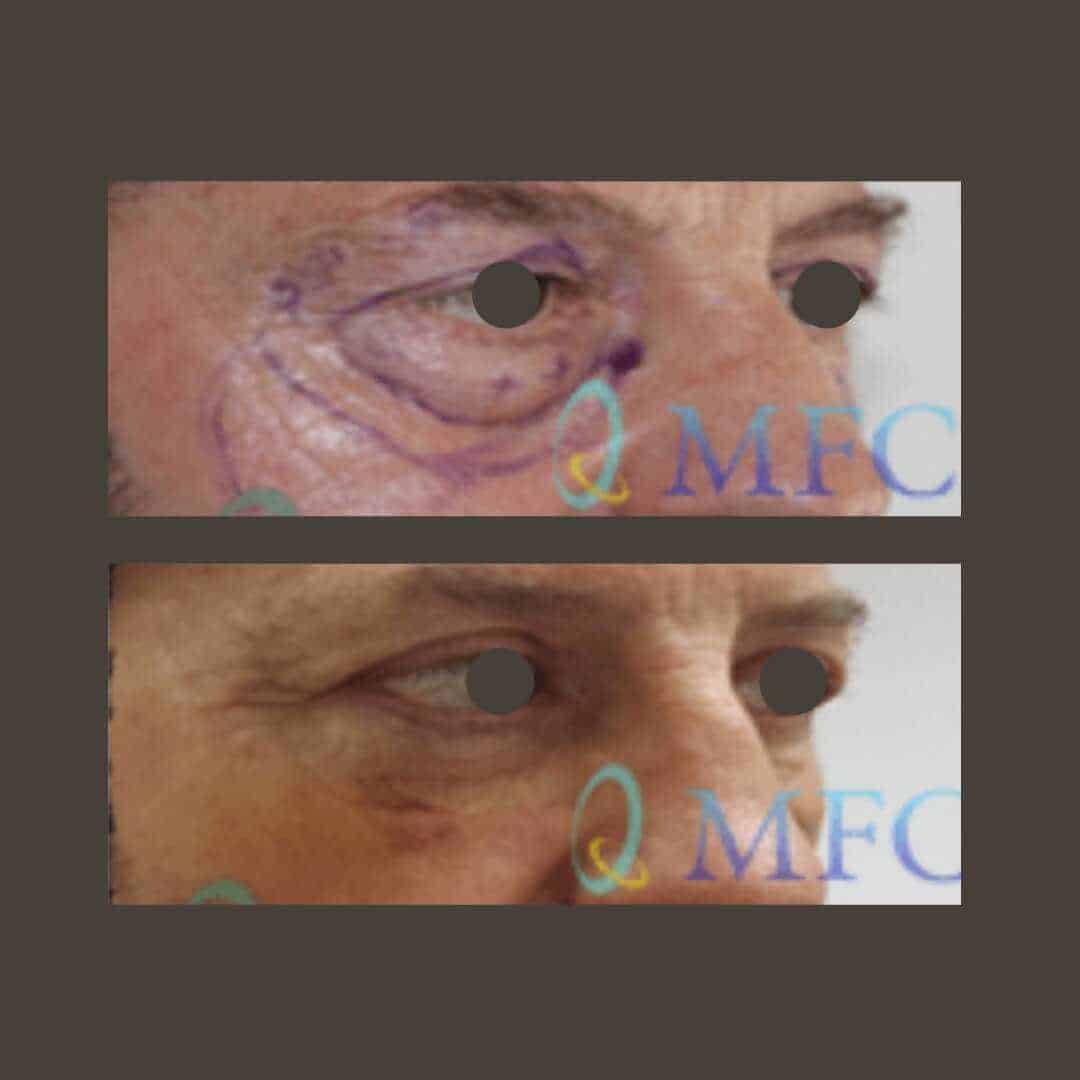 cirugia arrugas ojos madrid (4)