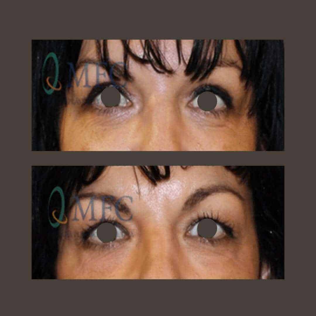 cirugia arrugas ojos madrid (5)