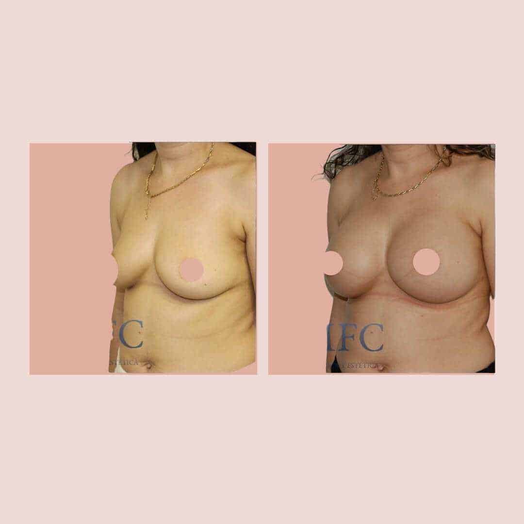 cirugía mamaria antes y después