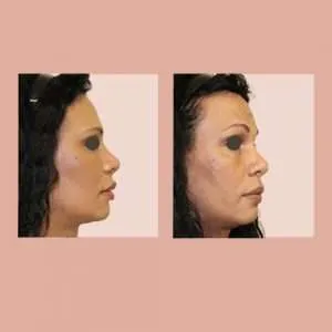 cirugia elevacion cejas madrid (2)