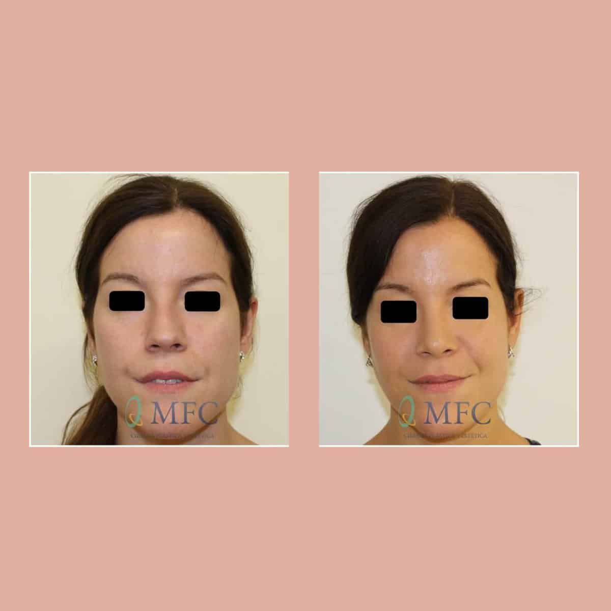 cirugia nariz rinoplastia madrid (1)