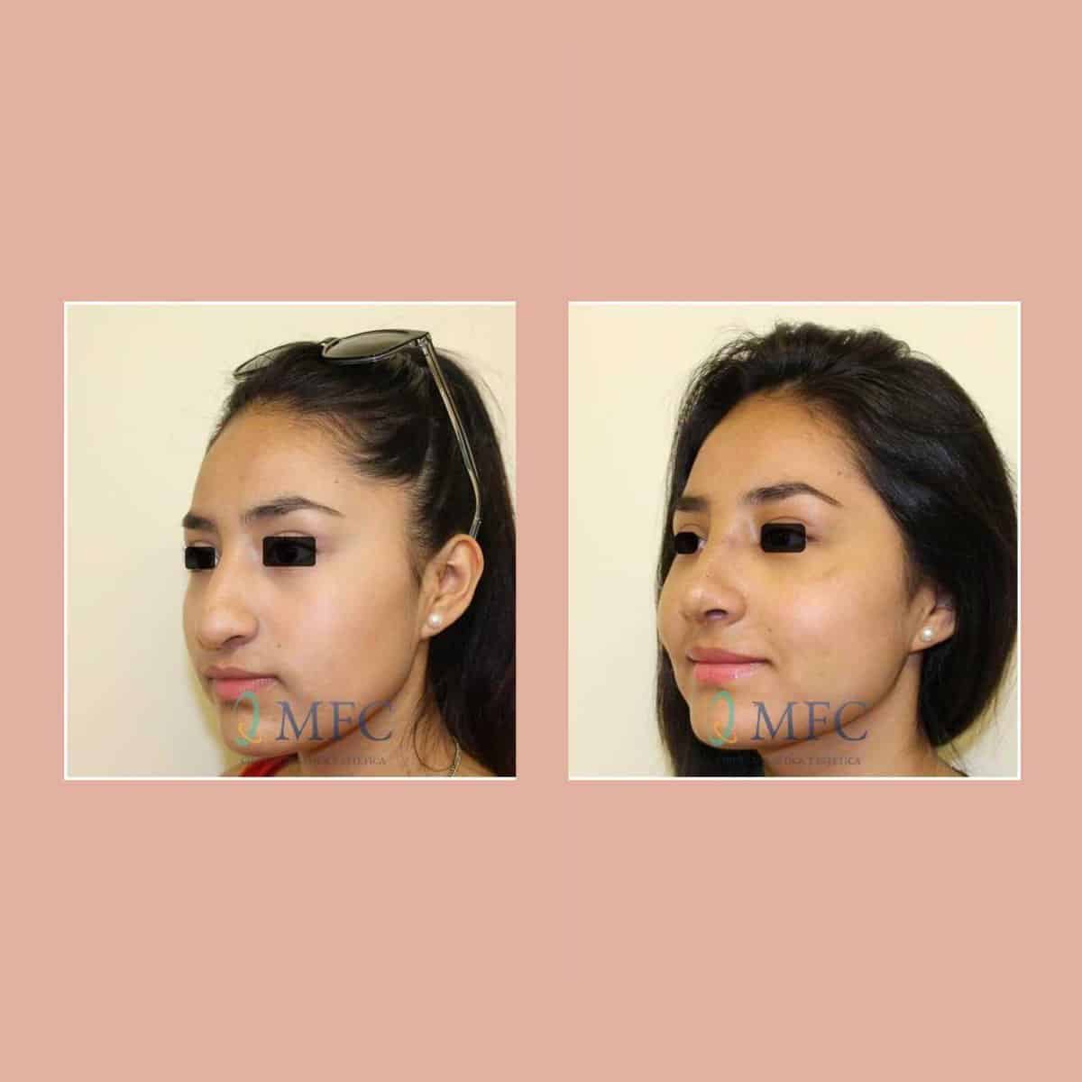 cirugia nariz rinoplastia madrid (17)