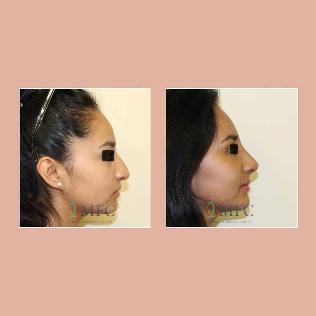 cirugia nariz rinoplastia madrid (18)