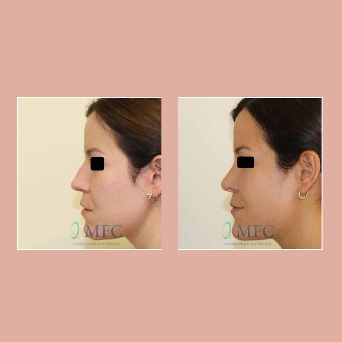 cirugia nariz rinoplastia madrid (2)