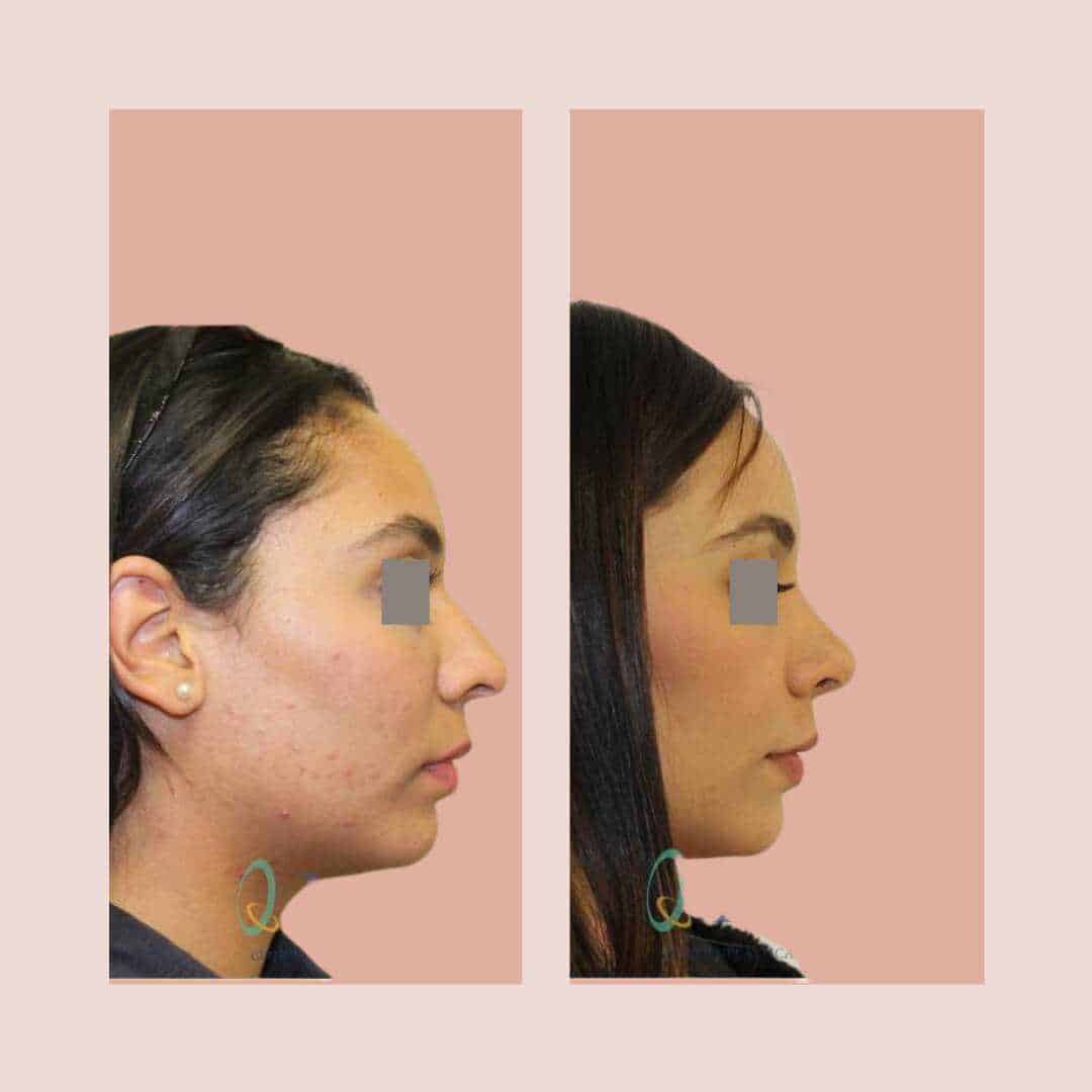 cirugia nariz rinoplastia madrid (24)
