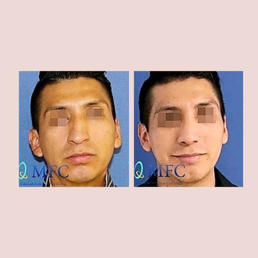 cirugia nariz rinoplastia madrid (28)