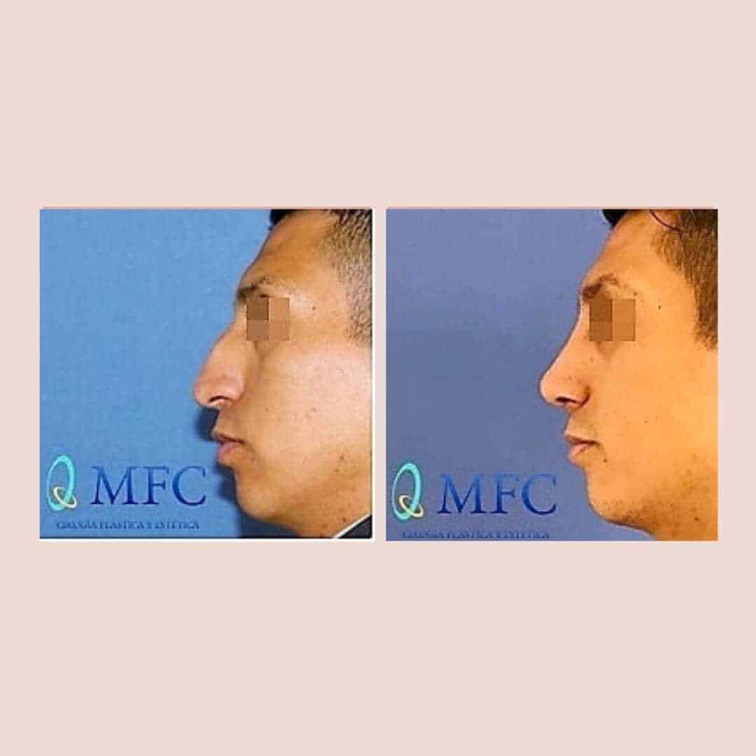 cirugia nariz rinoplastia madrid (29)