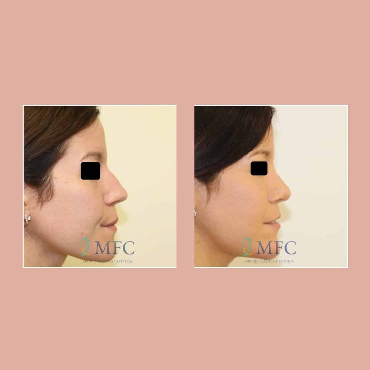 cirugia nariz rinoplastia madrid (3)