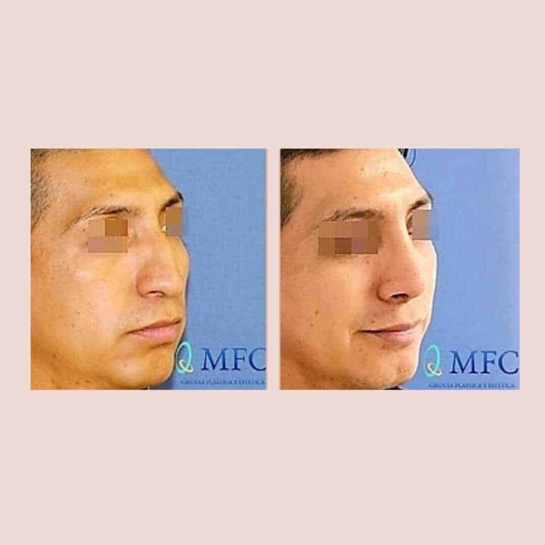 cirugia nariz rinoplastia madrid (30)