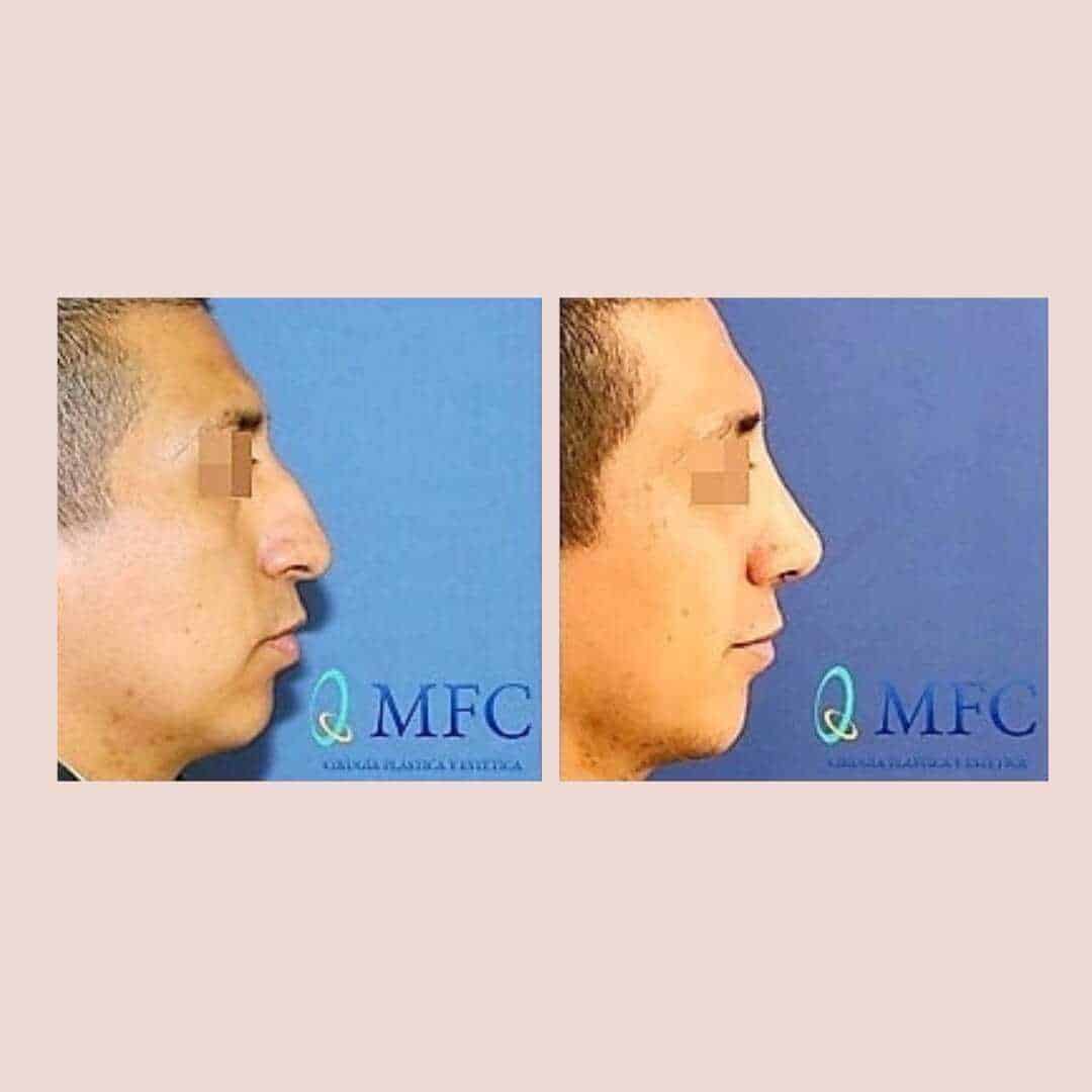 cirugia nariz rinoplastia madrid (31)