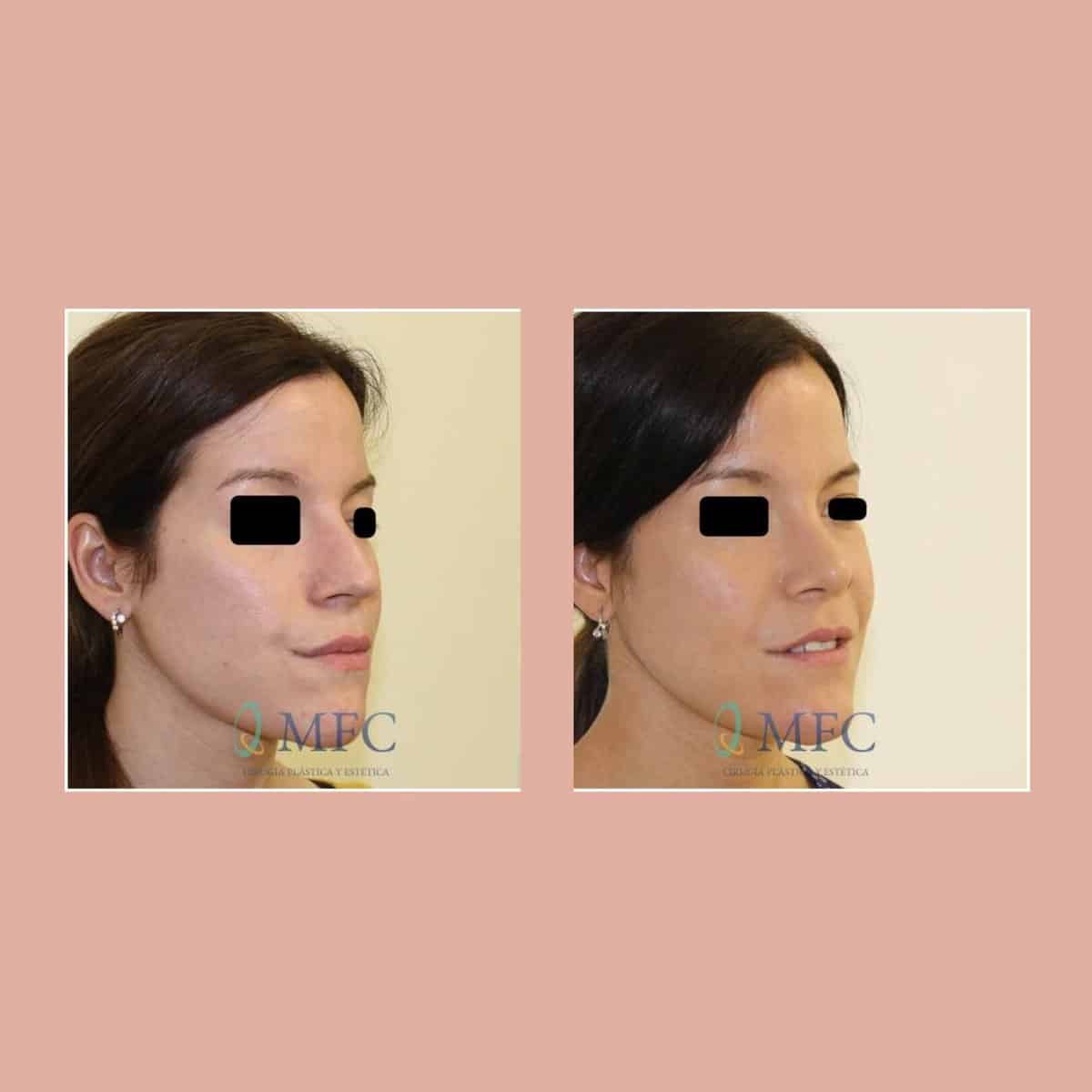 cirugia nariz rinoplastia madrid (4)