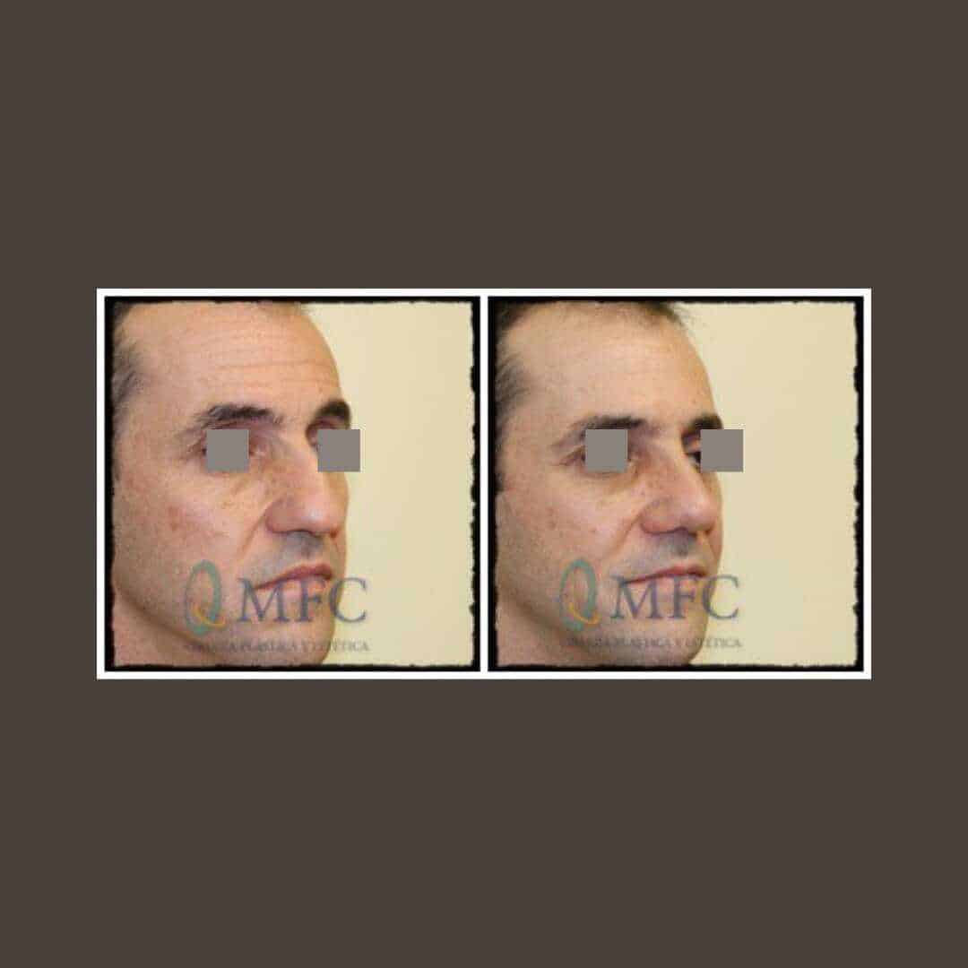 cirugia nariz rinoplastia madrid (47)