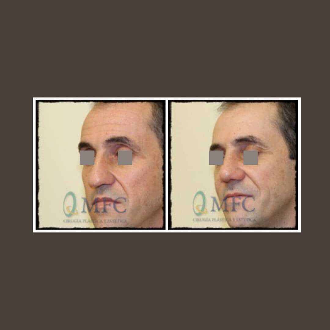 cirugia nariz rinoplastia madrid (48)