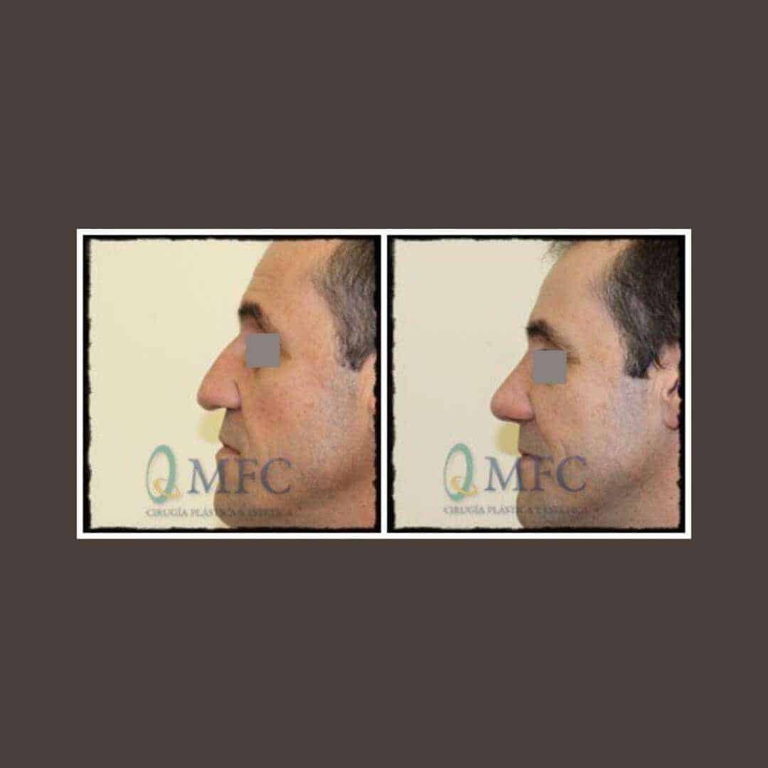 cirugia nariz rinoplastia madrid (49)