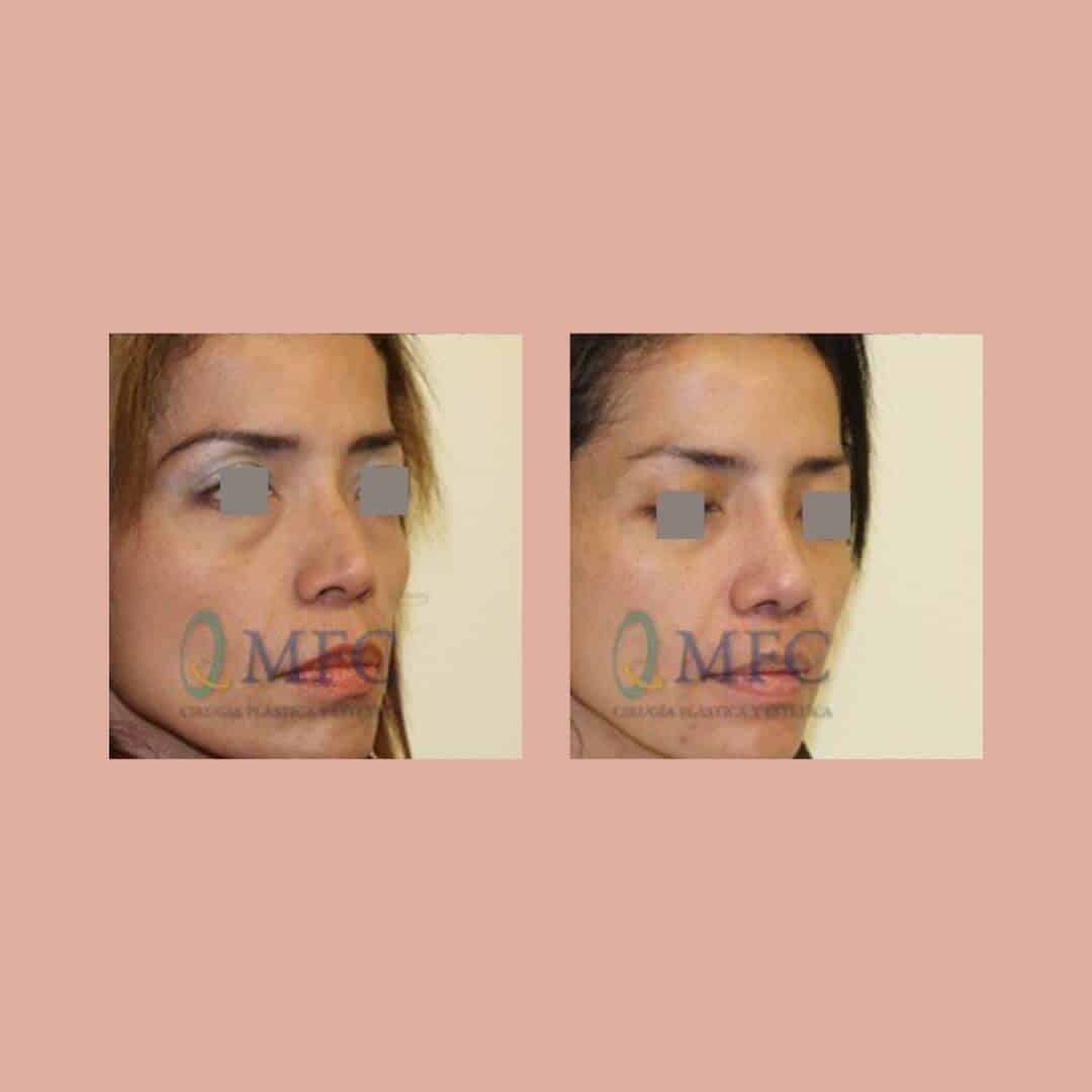 cirugia nariz rinoplastia madrid (51)