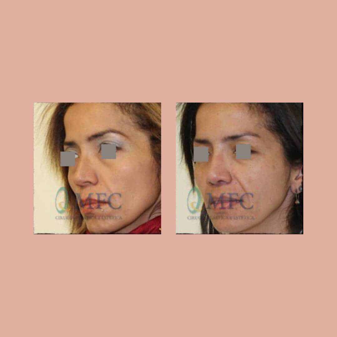 cirugia nariz rinoplastia madrid (52)