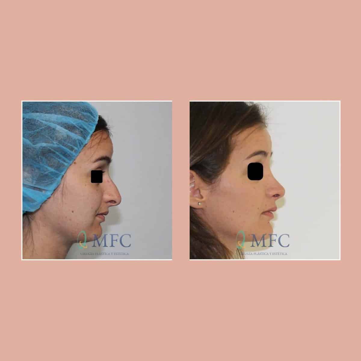 cirugia nariz rinoplastia madrid (7)