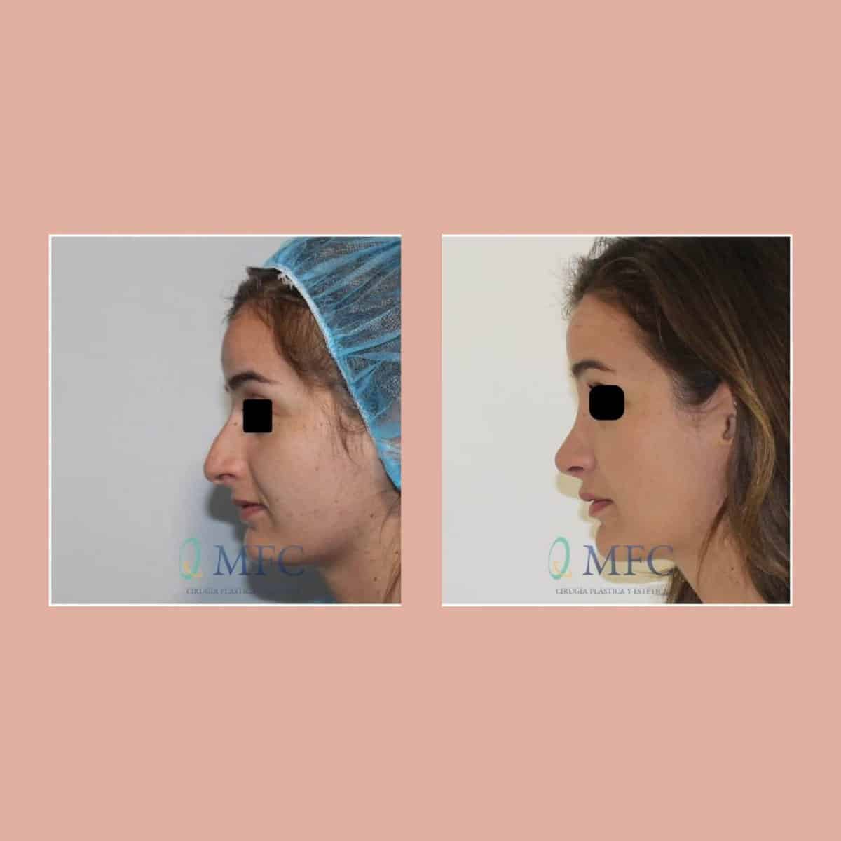 cirugia nariz rinoplastia madrid (9)