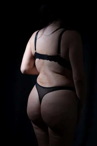 lipotransferencia a nalgas gluteos madrid 4