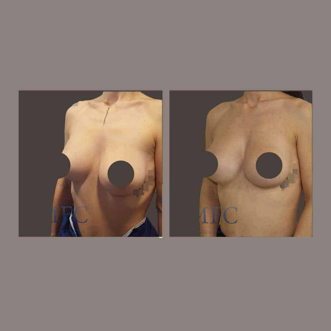 recambio implantes mamarios madrid (1)