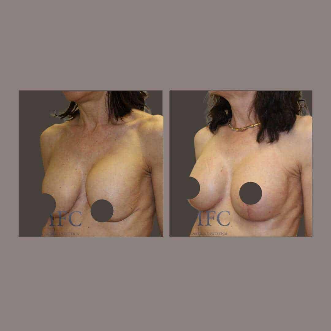 recambio implantes mamarios madrid (10)