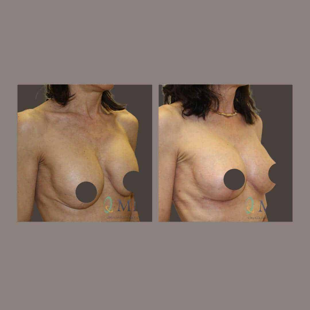 recambio implantes mamarios madrid (11)