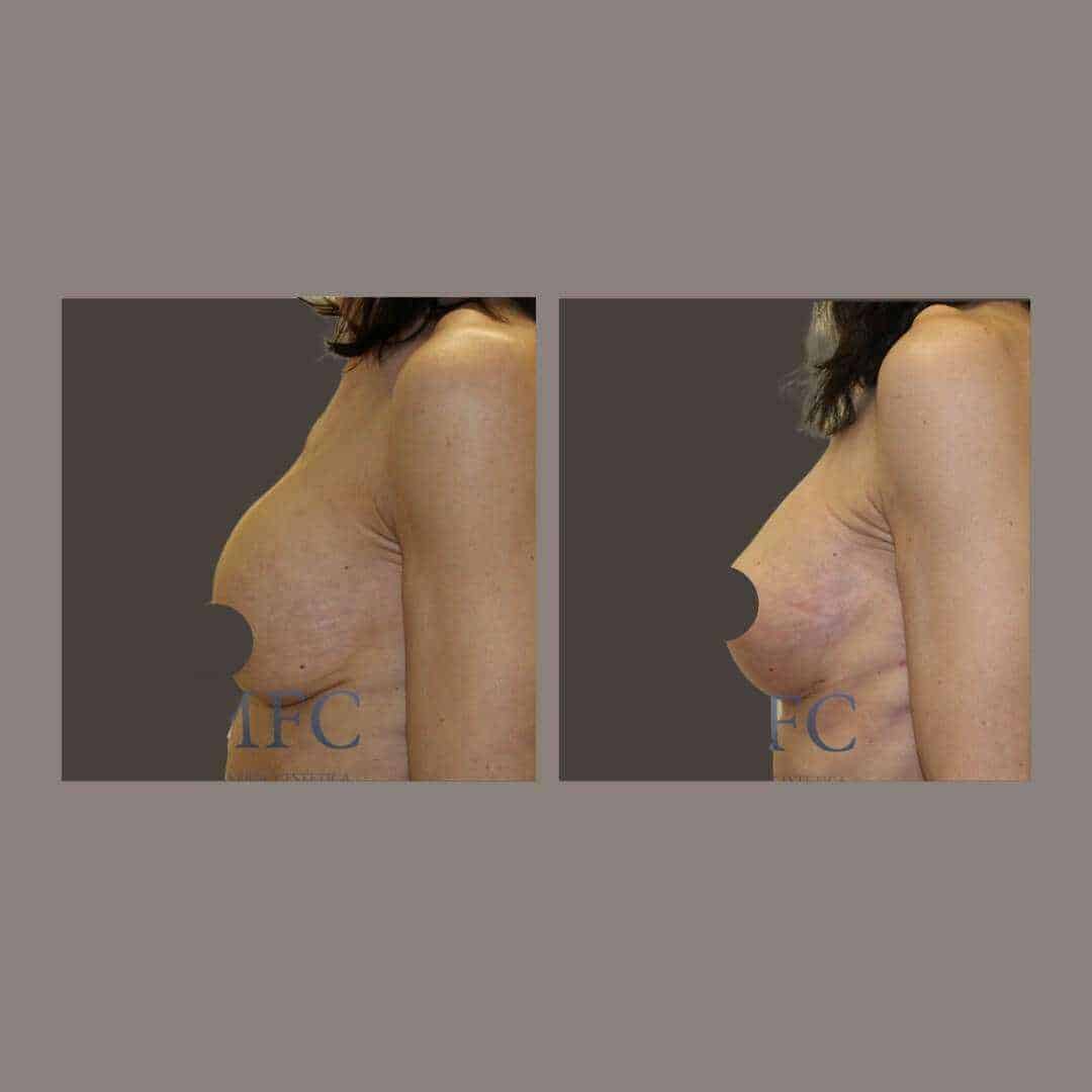 recambio implantes mamarios madrid (13)