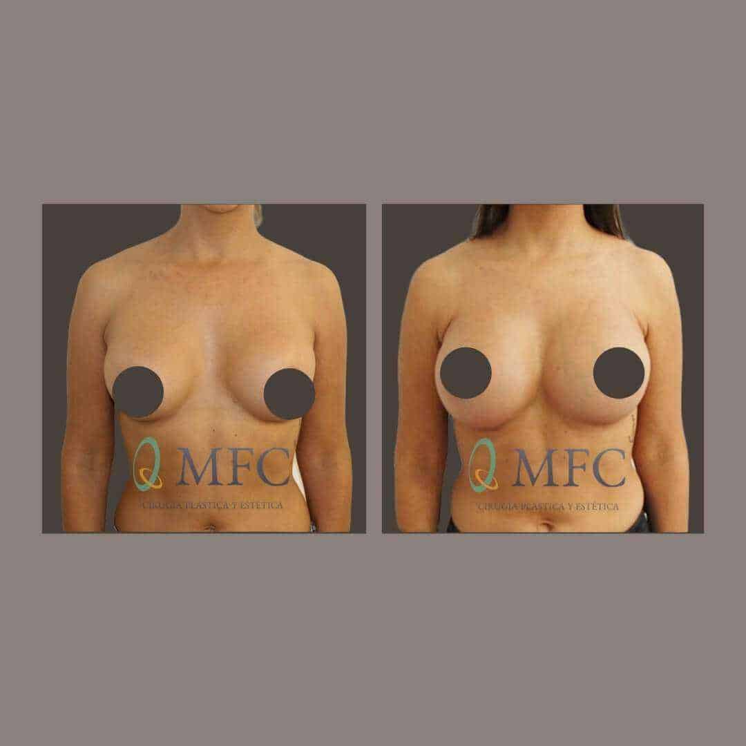 recambio implantes mamarios madrid (5)