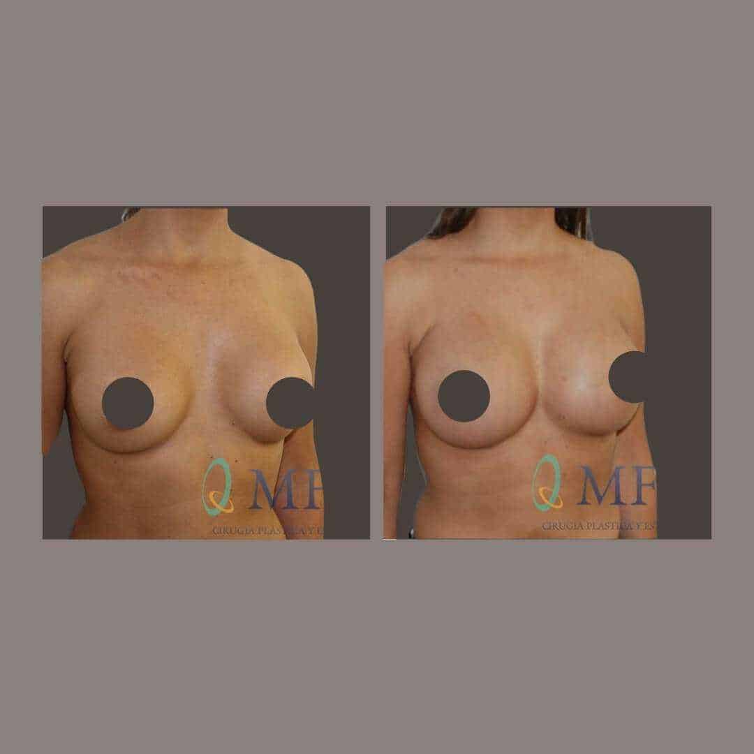 recambio implantes mamarios madrid (6)
