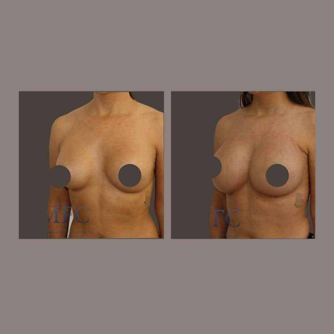 recambio implantes mamarios madrid (7)