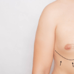 How to know if I have Gynecomastia or it's just fat in the blog of the aesthetic clinic Sculpture Clinic Madrid Spain