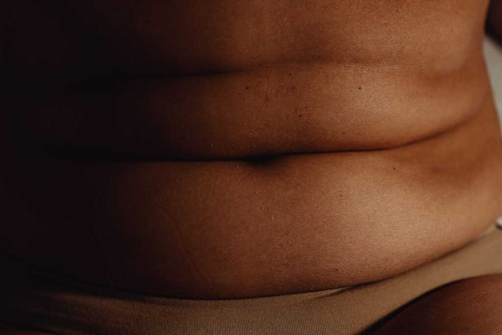 Can an abdominoplasty be performed when overweight?