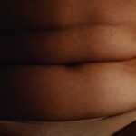 Can an abdominoplasty be performed when overweight?