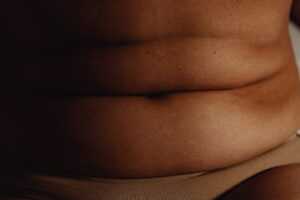 Se puede hacer una abdominoplastia con sobrepeso