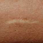 abdominoplasty scar