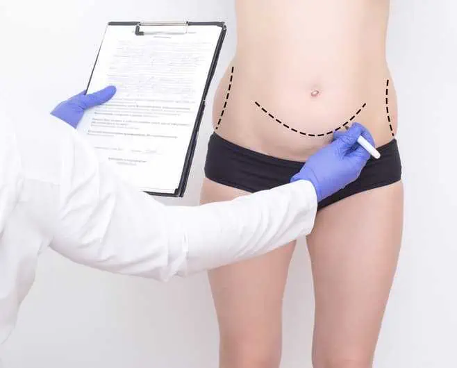 cita previa abdominiplastia