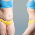 What you should know before undergoing abdominoplasty