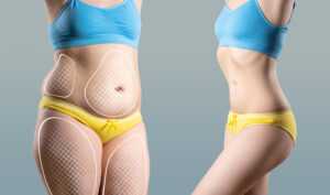 Qué debes saber antes de someterte a una abdominoplastia