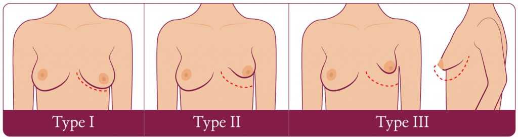 graph of tuberous breasts