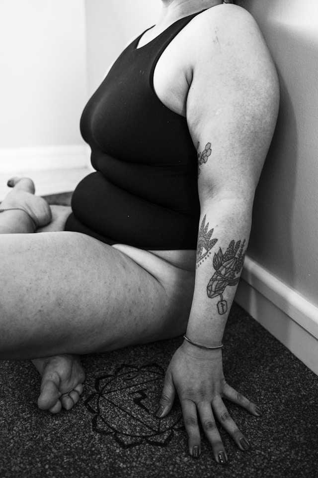 lipedema grado1