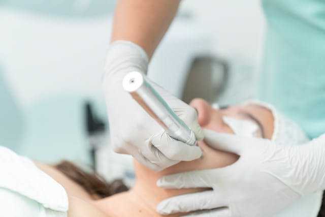 radiofrecuencia facial
