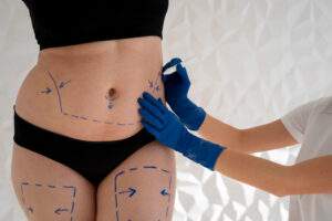 liposuccion de abdomen